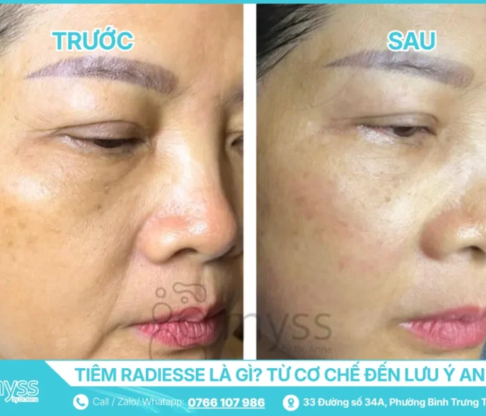 Tiêm Radiesse Là Gì - Bác Sĩ Da Liễu Giải Thích Từ Cơ Chế Đến Lưu Ý An Toàn