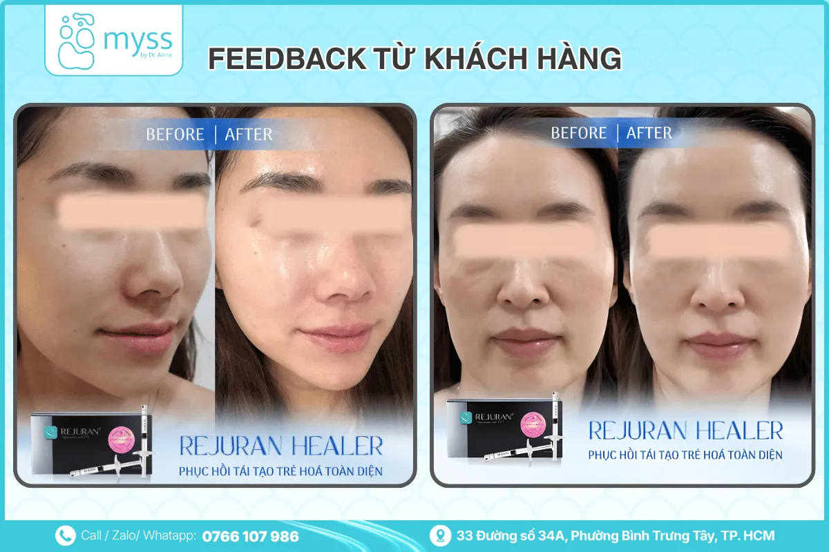 Tiêm Rejuran cải thiện chất lượng da